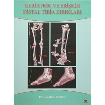 Geriatrik Ve Erişkin Distal Tibia Kırıkları