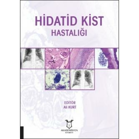 Hidatid Kist Hastalığı - Ali Kurt