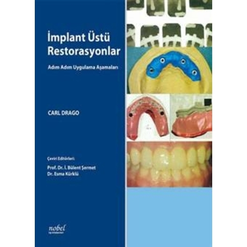 Implant Üstü Restorasyonlar: Adım Adım Uygulama Aşamaları