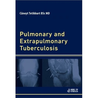 Pulmonary And Extrapulmonary Tuberculosis Cüneyt Tetikkurt