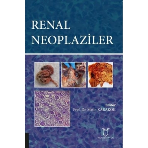 Renal Neoplaziler